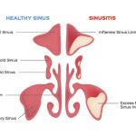 Sinus Pressure & Headache Treatments