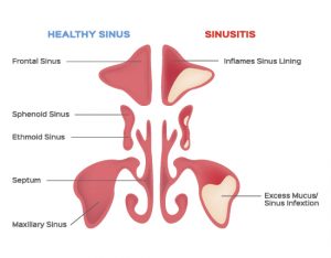 Sinus Pressure & Headache Treatments